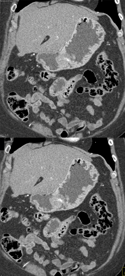 Suspected GI Bleed