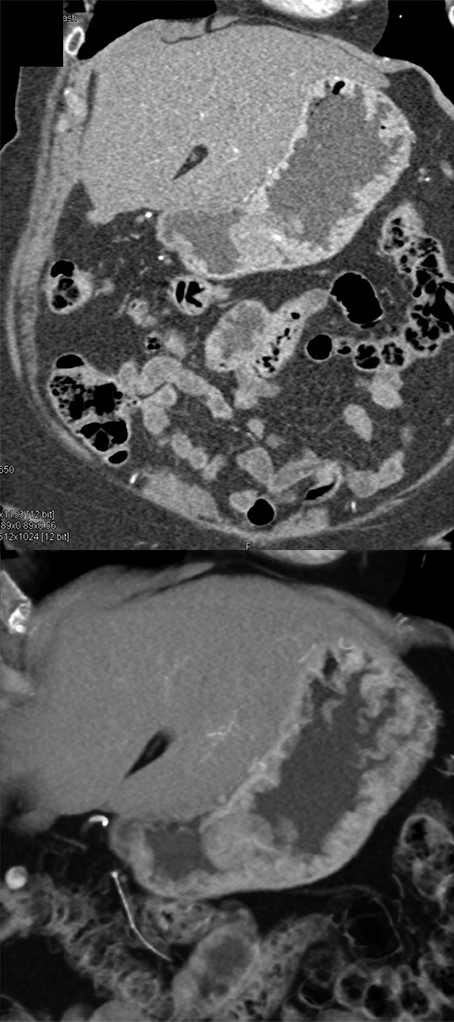 Suspected GI Bleed