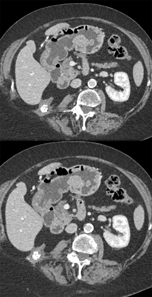 RCC Metastatic to the Stomach