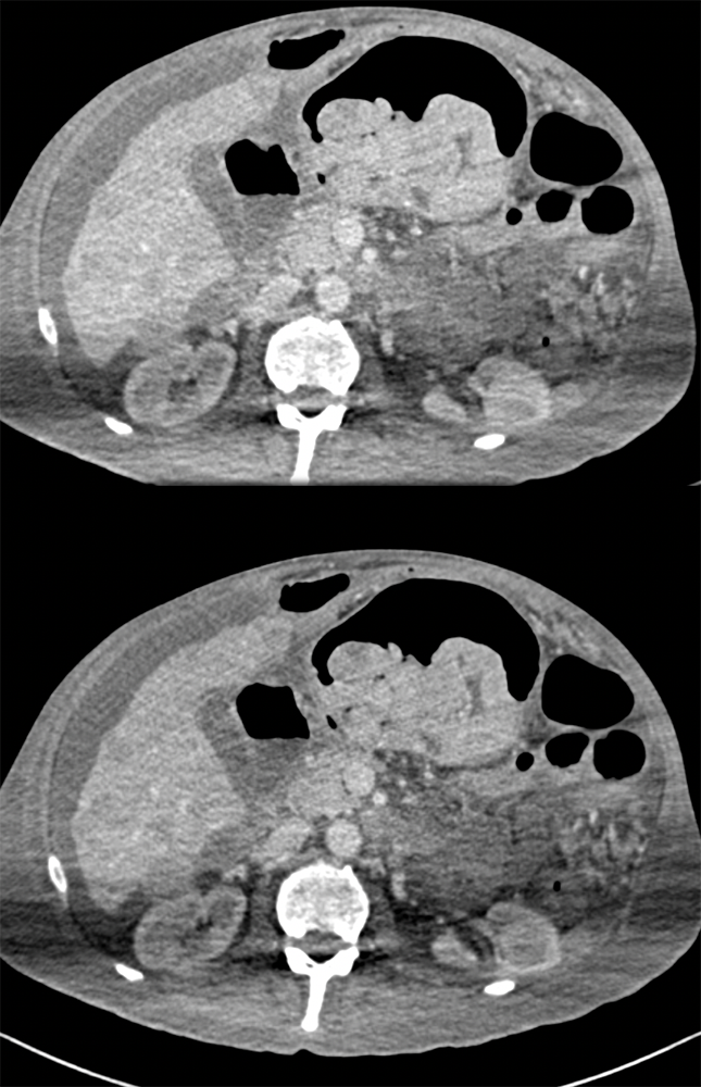 RCC Metastatic to the Stomach with GI Bleed