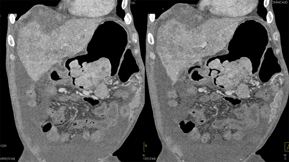 RCC Metastatic to the Stomach with GI Bleed