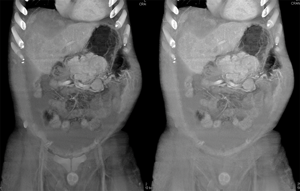 RCC Metastatic to the Stomach with GI Bleed