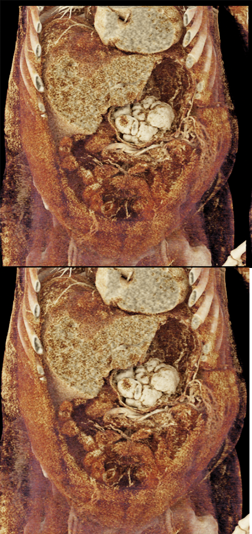 RCC Metastatic to the Stomach with GI Bleed