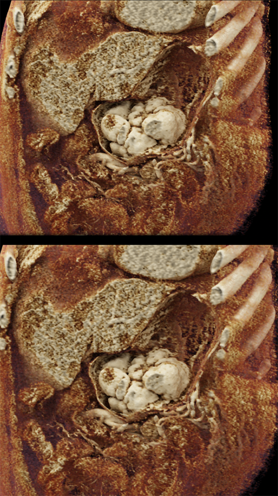 RCC Metastatic to the Stomach with GI Bleed