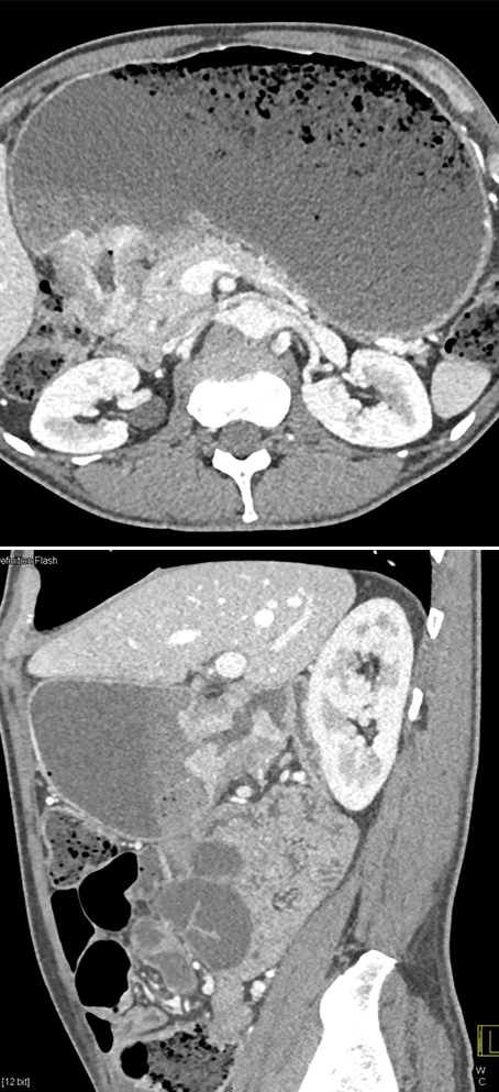 Gastric Adenocarcinoma with Gastric Outlet Obstruction