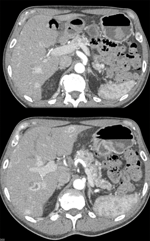 RCC Metastatic to Stomach with Ulceration and Bleed