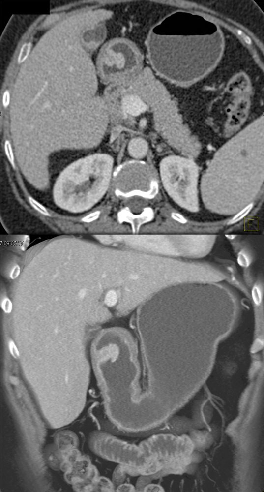 Gastric Polypoid Mass: Inflammatory Polyp