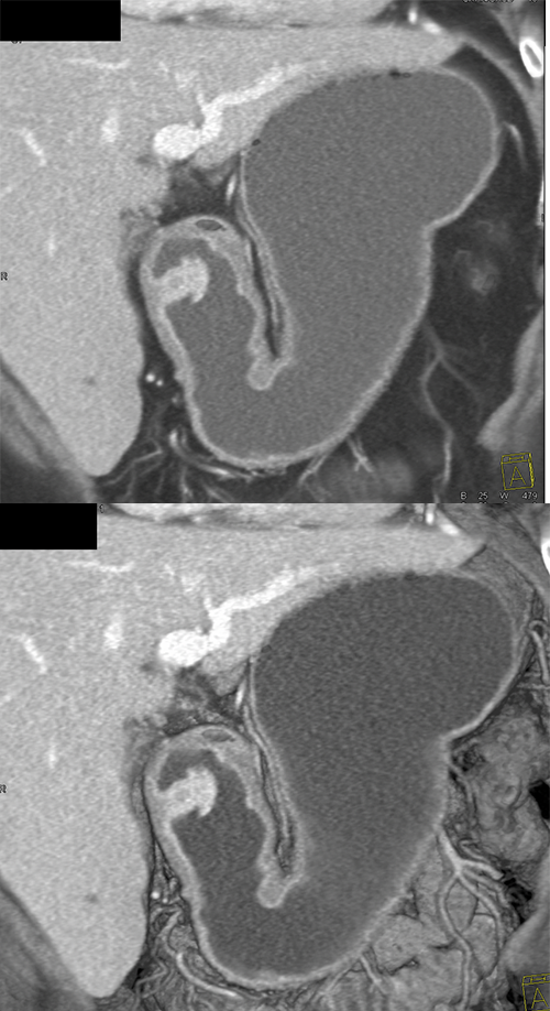 Gastric Polypoid Mass: Inflammatory Polyp