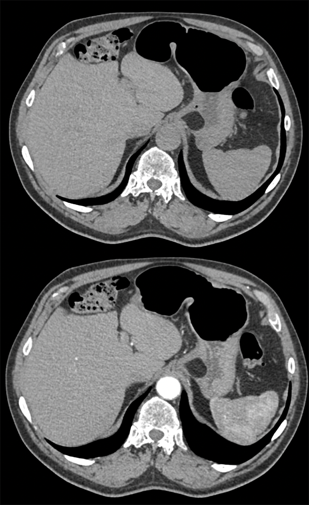 Gastric Lipoma