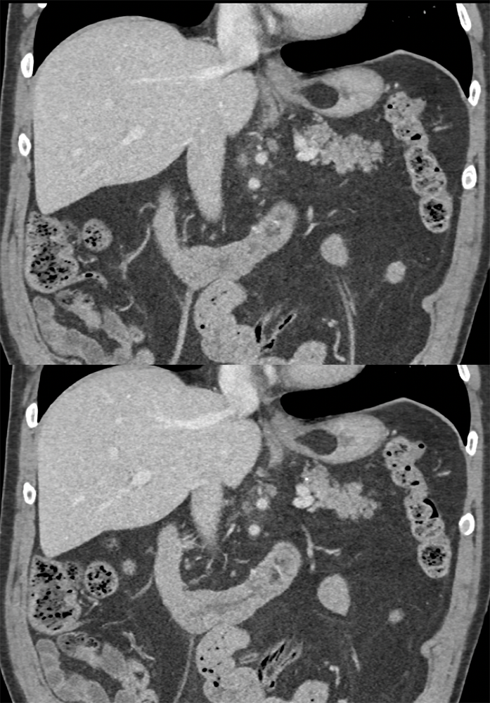 Gastric Lipoma