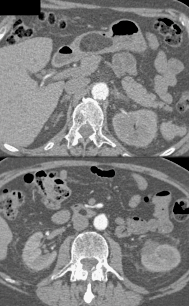 Gastric and Small Bowel Lipomas