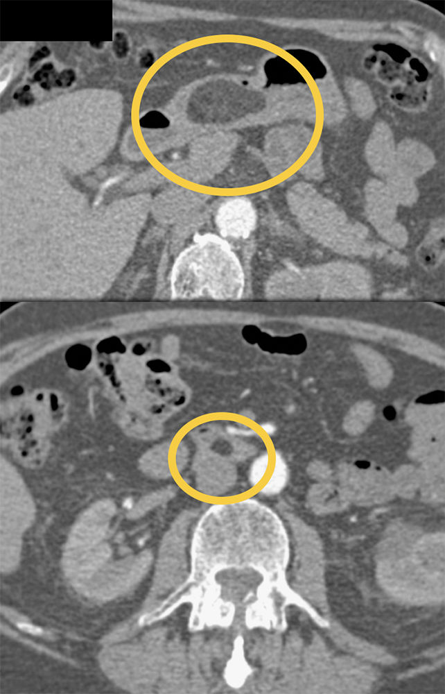 Gastric and Small Bowel Lipomas