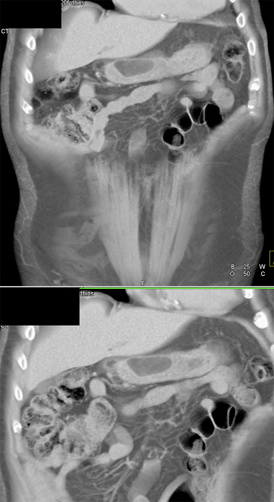 Gastric and Small Bowel Lipomas