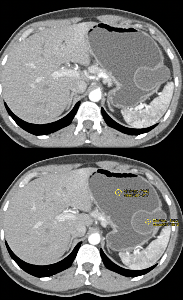 ? Gastric Duplication Cyst