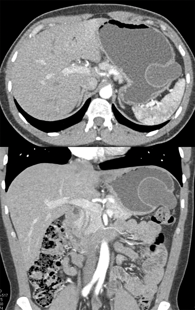 Gastric Duplication Cyst