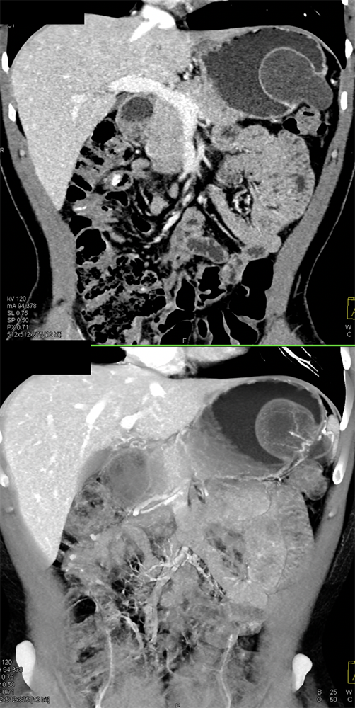 Gastric Duplication Cyst