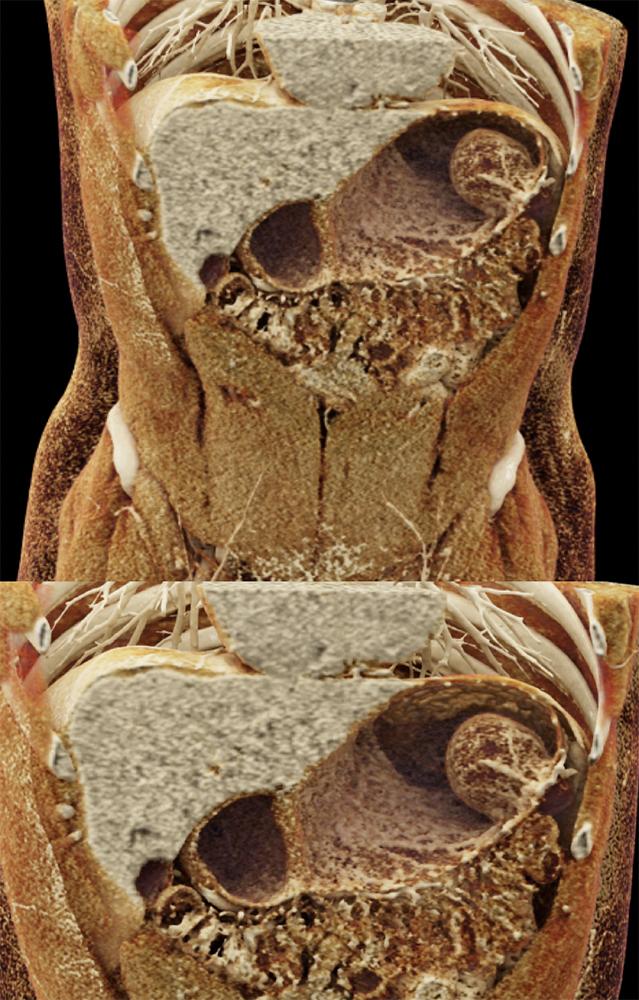 Gastric Duplication Cyst