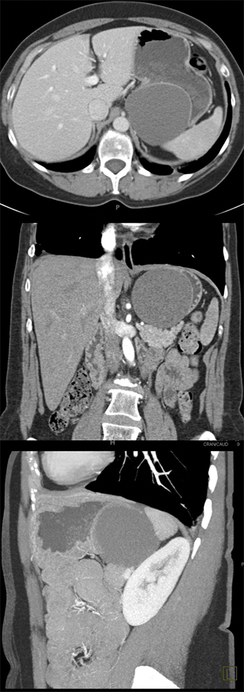 Gastric Duplication Cyst