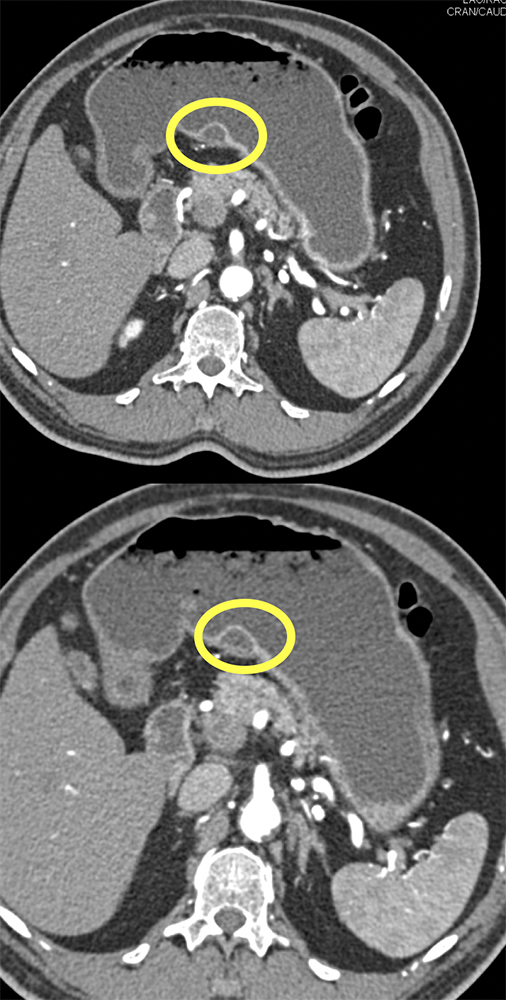 Abdominal Pain