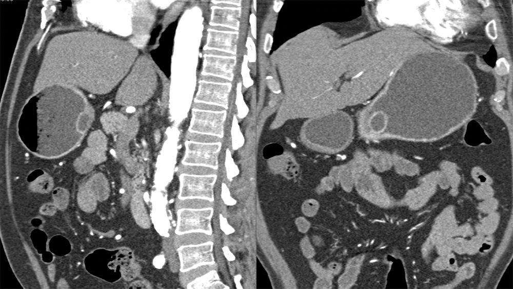 Abdominal Pain