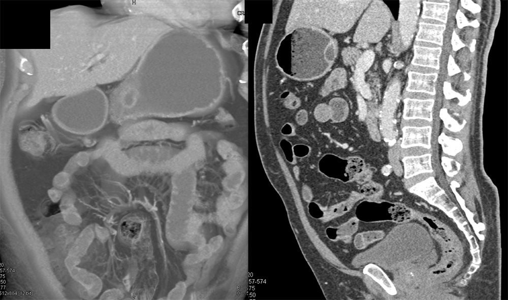 Abdominal Pain