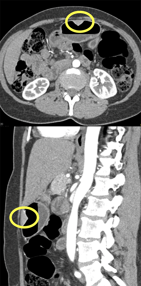 Abdominal Pain