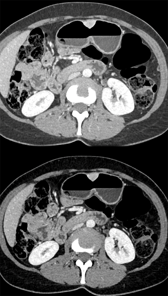 Abdominal Pain