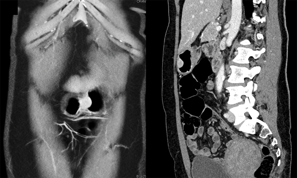 Abdominal Pain