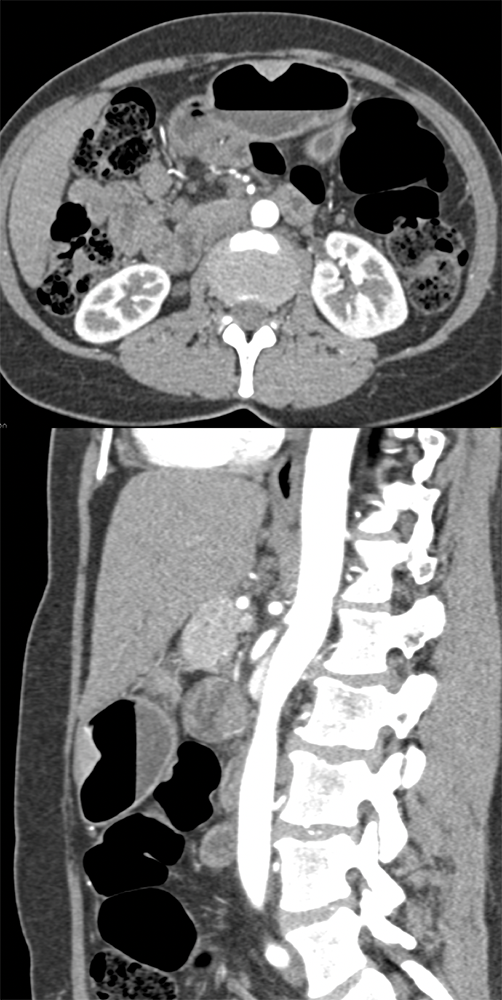 Heterotopic Pancreas Tissue