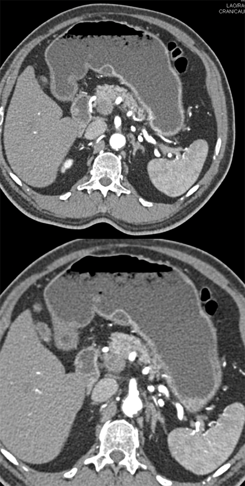 Heterotopic Pancreas Simulates Cystic Tumor