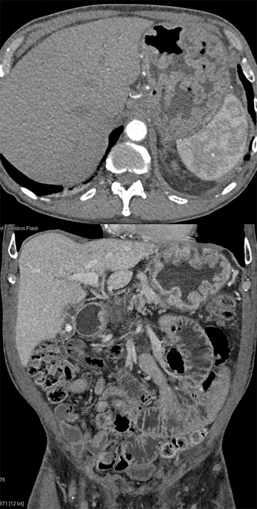 Chemical Gastritis