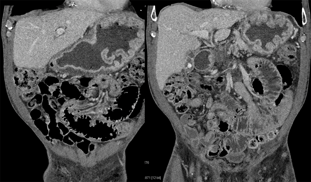 Chemical Gastritis from NSAIDs