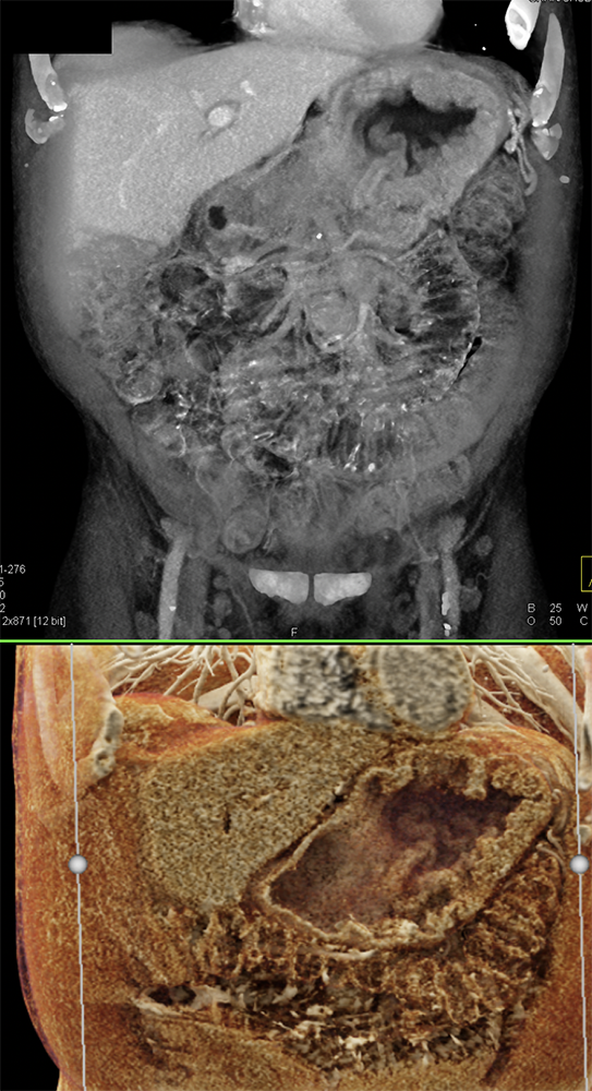 Chemical Gastritis from NSAIDs