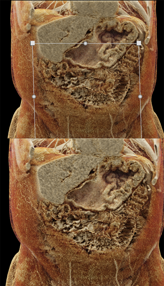 Chemical Gastritis from NSAIDs