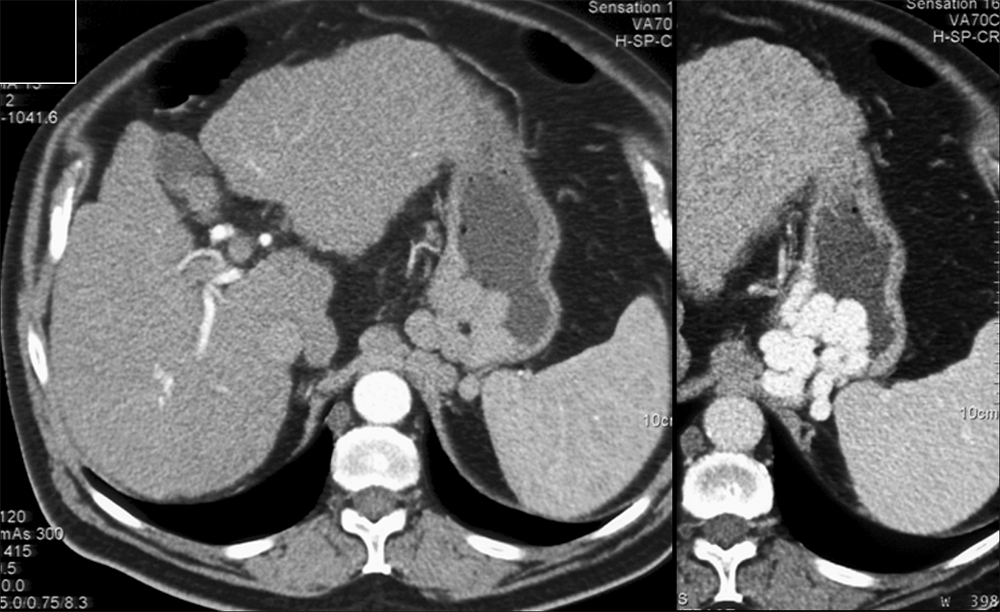 Cirrhosis with Gastric Varices