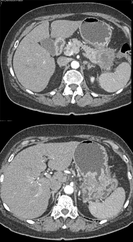 Adenocarcinoma Stomach with Ulcer Invades TOP