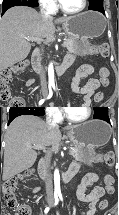 Adenocarcinoma Stomach with Ulcer Invades TOP