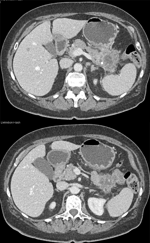 Adenocarcinoma Stomach with Ulcer Invades TOP