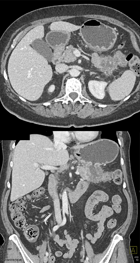 Adenocarcinoma Stomach with Ulcer Invades TOP