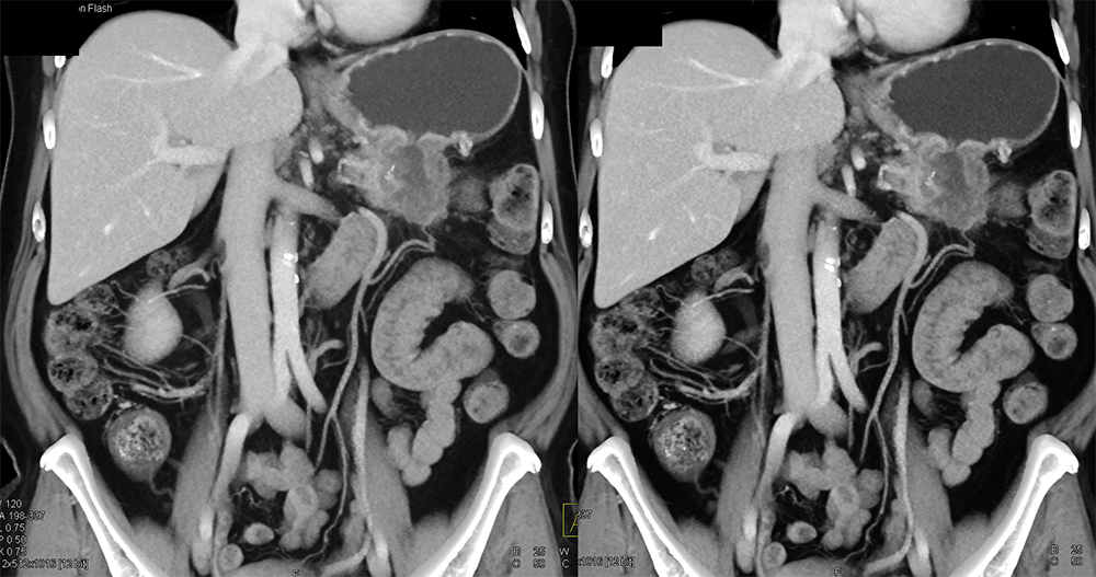 Adenocarcinoma Stomach with Ulcer Invades TOP