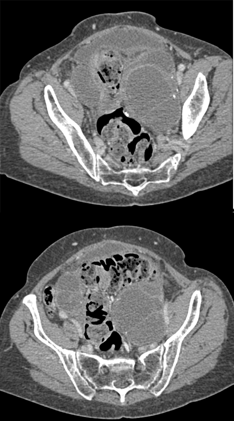 Krukenberg Tumor from Gastric Primary