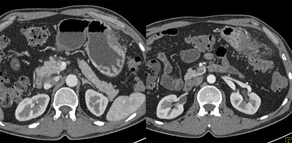 Gastric Adenocarcinoma with Perforation