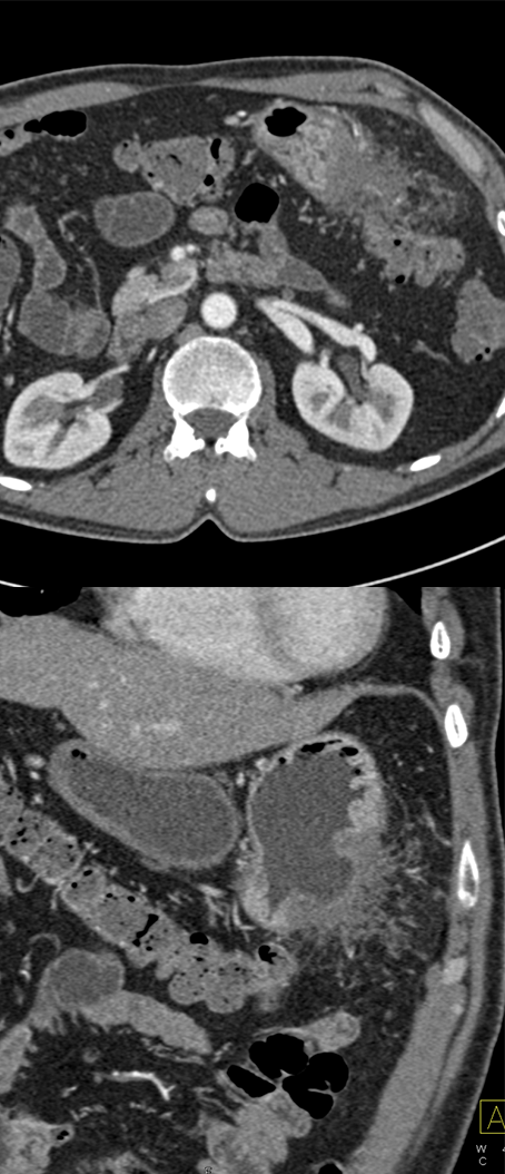 Gastric Adenocarcinoma with Perforation