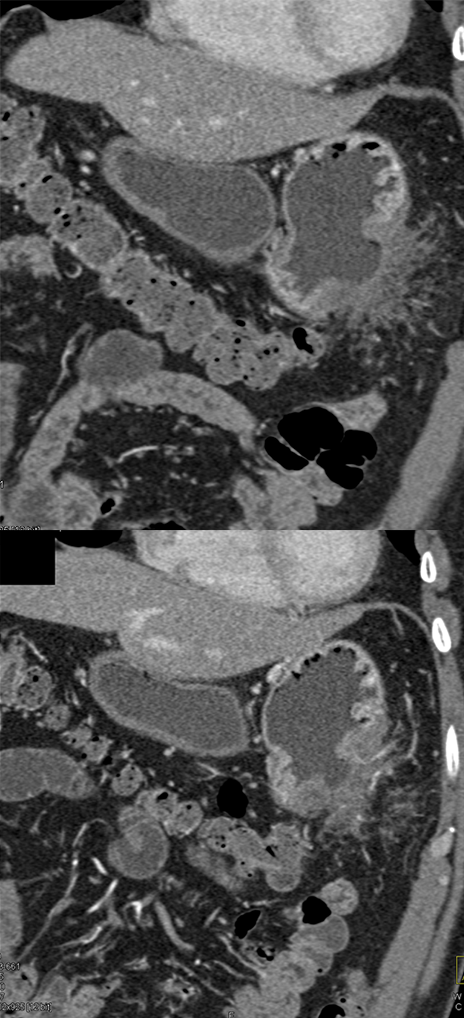 Gastric Adenocarcinoma with Perforation