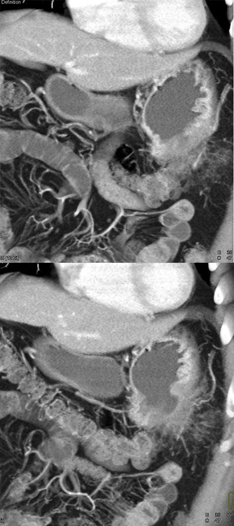 Gastric Adenocarcinoma with Perforation