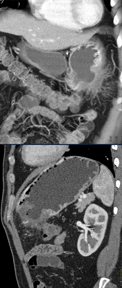 Gastric Adenocarcinoma with Perforation