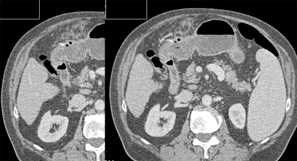 Perforated Gastric Ulcer