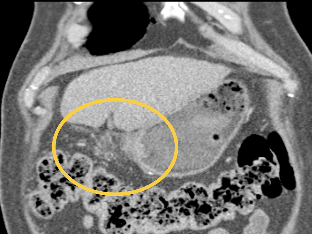 Perforated Gastric Ulcer