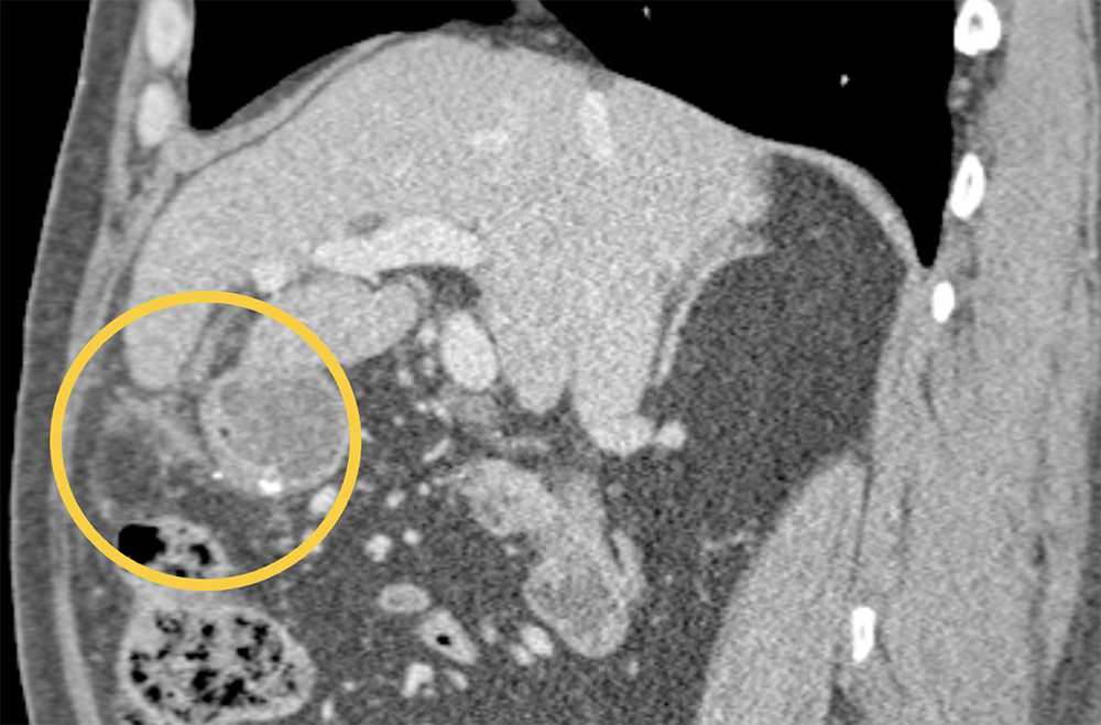 Perforated Gastric Ulcer