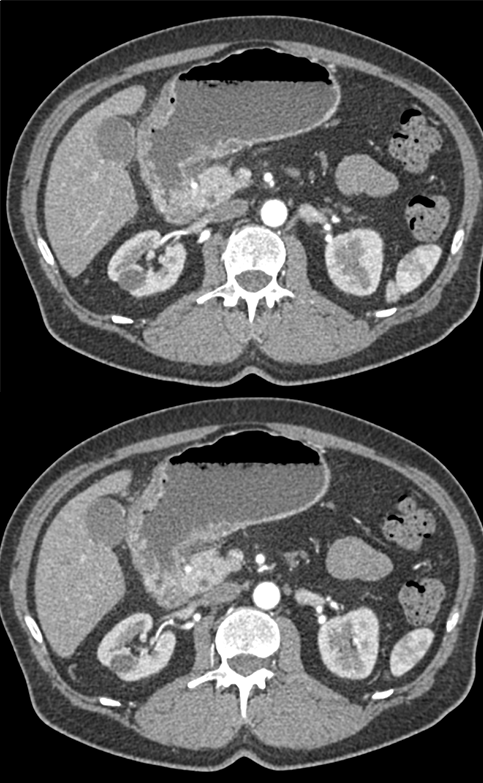 B-Cell Lymphoma Stomach as Incidental Finding (suspect adenoca stomach)